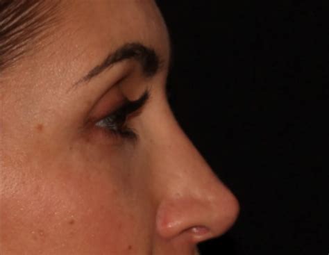 Juvederm Voluma Before And After Photos Albany Medspa The