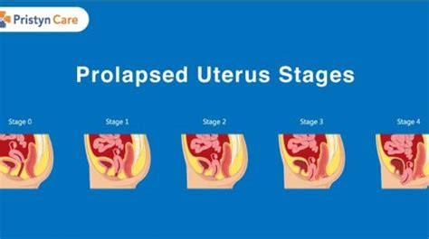 Most Common Reasons For Uterus Removal Pristyn Care