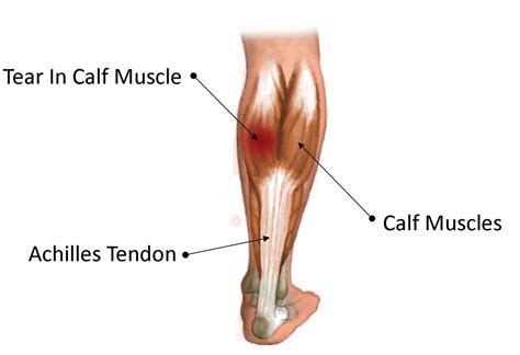 common  leg  calf injuries  family physio