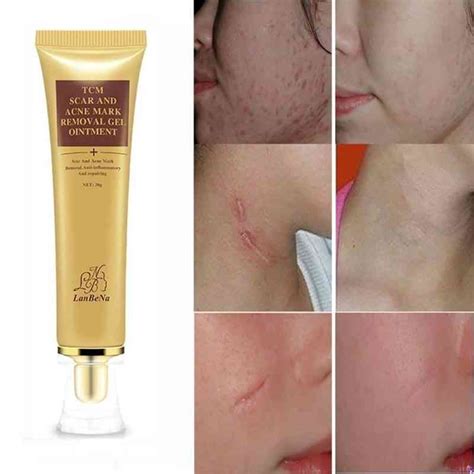 tcm cream scar removal gel  price sri lanka dmarklk