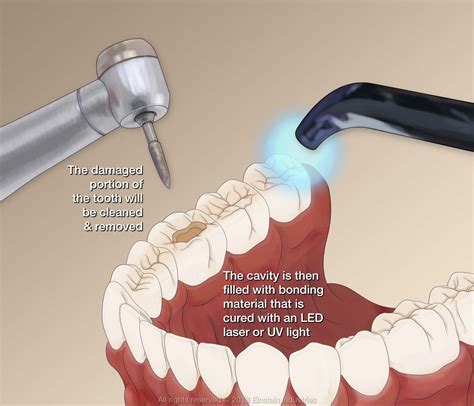 dental fillings