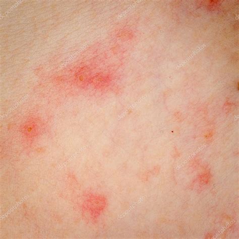 allergische hautausschlaege dermatitis ekzem haut stockfoto