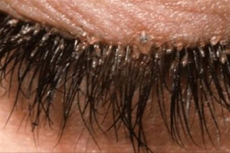 electron microscopy  imgur eyelash mites eyelash mites