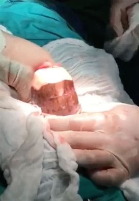 surgeons remove 18 inch yucca root from man s bottom after he uses it