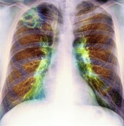 drug  lung damage  ray photograph