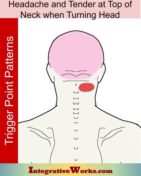 headache  tender top  neck  turning integrative works