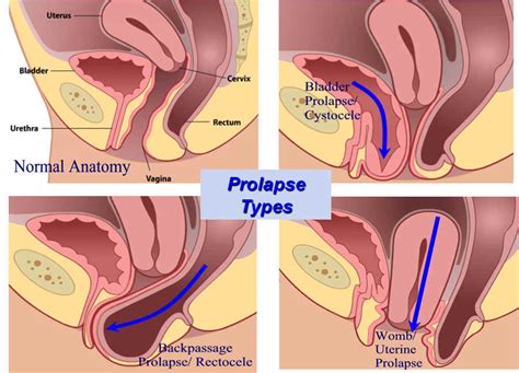 Pelvic Organ Prolapse Vanea Posture Pelvic Floor