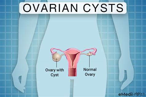 Ovarian Cysts 101 Causes Signs Treatment And Myths