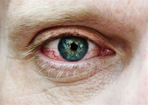 top 19 alergia en la piel y ojos rojos en iyi 2022
