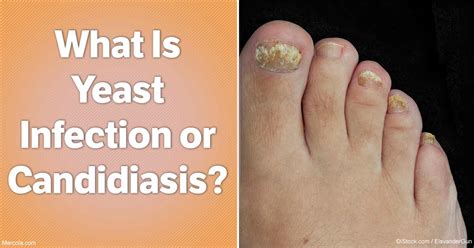 What Is Yeast Infection Or Candidiasis