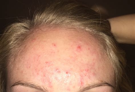 Forehead Acne Won T Heal General Acne Discussion By Kelly00456