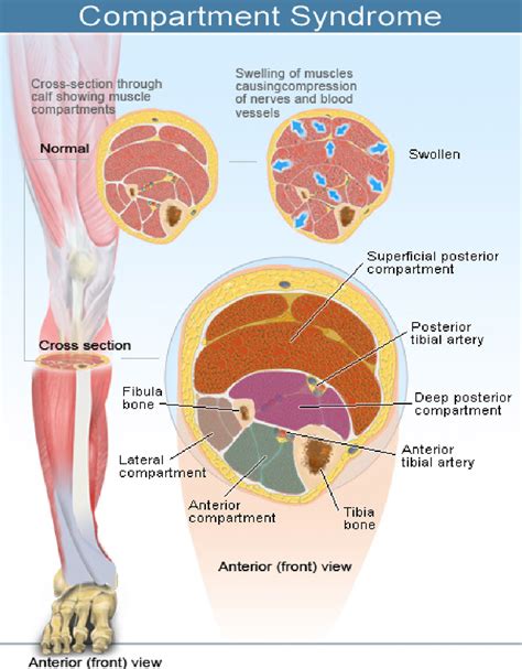 compartment syndrome  orthopedic sports medicine institute