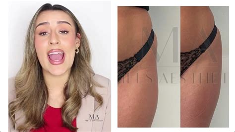 hips hip dips and buttocks filler treatment non surgical bbl youtube
