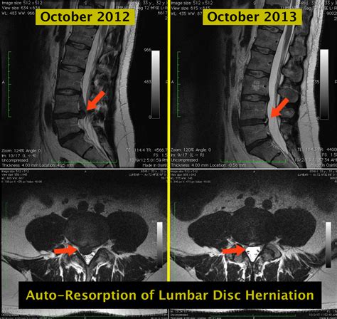 auto resorption  lumbar disc herniation  pain source  learning  pain painless