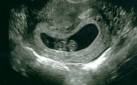 ultrasound pic