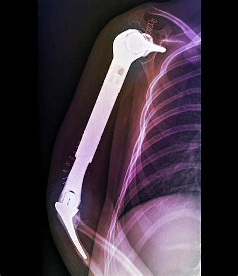 total upper arm bone replacement photograph  zephyr pixels