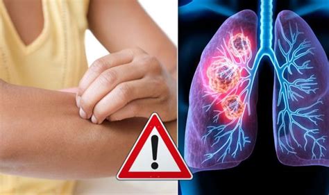 lung cancer the patchy skin rash you should never ignore should you