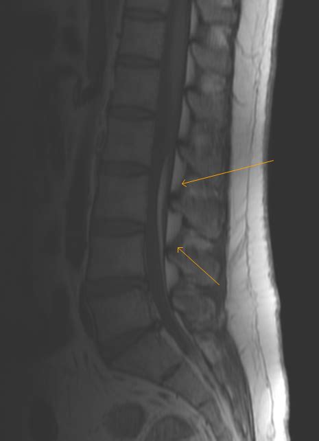 lipomatous filum terminale sumers radiology blog