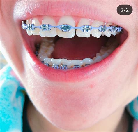 follow ya average girl for more pins ♛ braces colors braces teeth