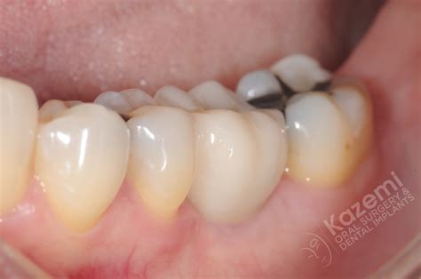 18 Dental Implant Connective Tissue Graft Kazemi Oral