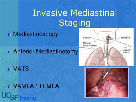 Echoendoscopic Lymph Node Staging In Lung Cancer An Endoscopic Alter…