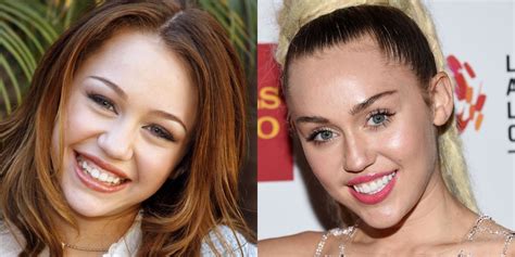 Celebrity Smiles Before And Afters Celebrity Dental Work