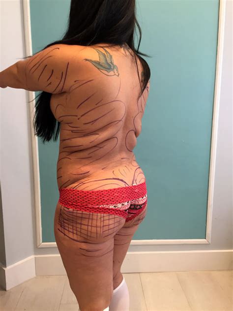 nurse has brazilian butt lift to be like kim kardashian life life