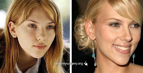 celebrity scarlett johansson before and after plastic surgery images rhinoplasty nose job