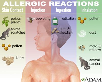 allergic reactions information mount sinai  york