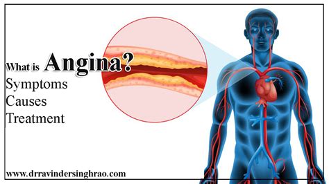 angina chest pain symptoms  treatment