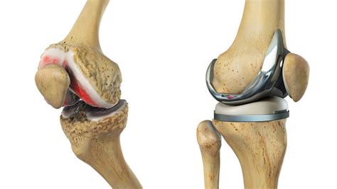 knee replacement surgery nyc  knee surgeon ny