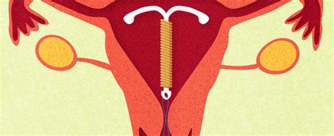 8 Things You Need To Know About Sex When You Have An Iud