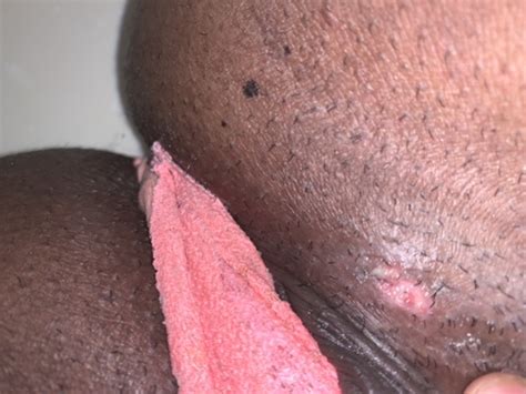 Please Help Shaved And Now This Could It Be Herpes Genital