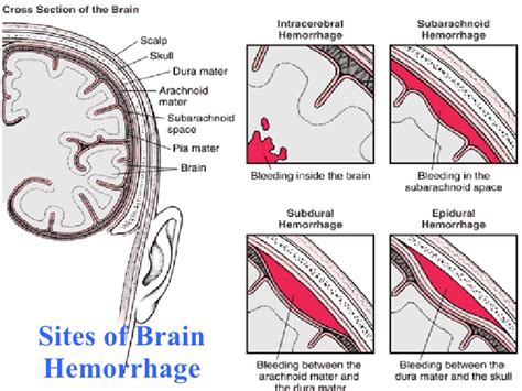 cerebrovascular disease ppt