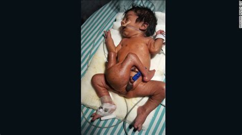 operan con éxito a un niño indio nacido con cuatro piernas y dos penes