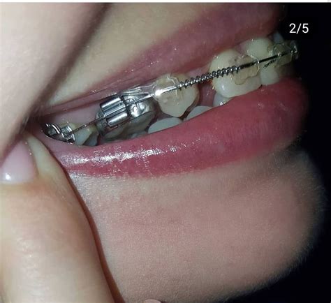 pin by metalmouthjoe martin on braces orthodontics braces perfect