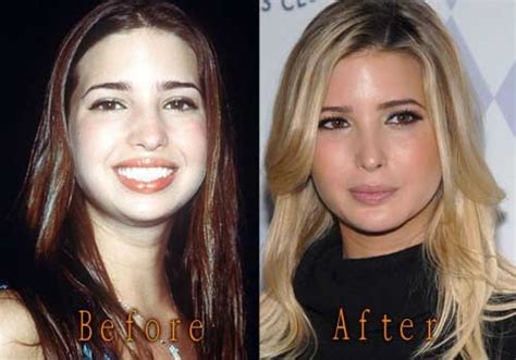 top celebrity surgery celebrity plastic surgery news before and after pictures