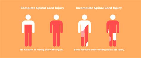 Difference Between A Complete Spinal Cord Injury And
