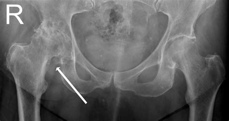 hip arthritis total hip replacement robin orthopaedics melbourne