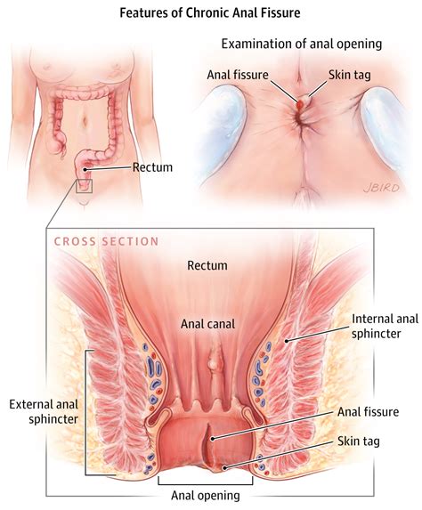 anal fissure gastroenterology jama jama network