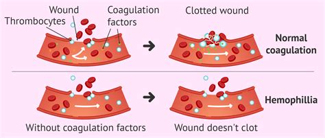 what is hemophilia causes symptoms and pregnancy