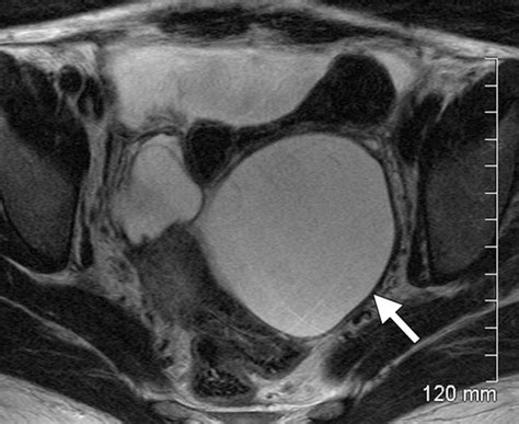 Uncommon Primary Pelvic Retroperitoneal Masses In Adults A Pattern