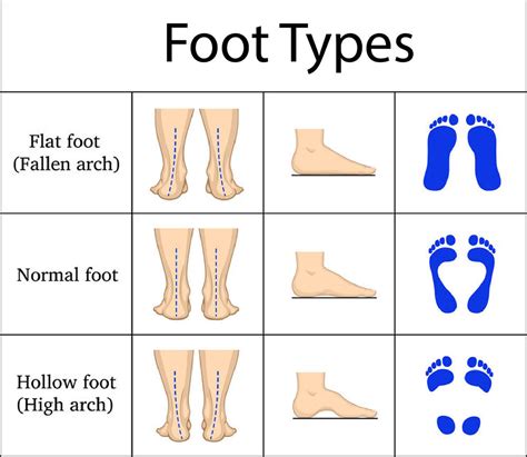 flat feet soul insole flat foot   flat feet