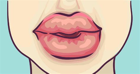 Swollen Lips Allergy Symptoms Causes Treatments And Home Remedies