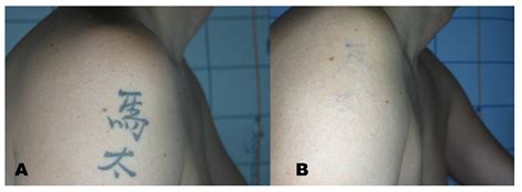 update    laser tattoo removal lymph nodes
