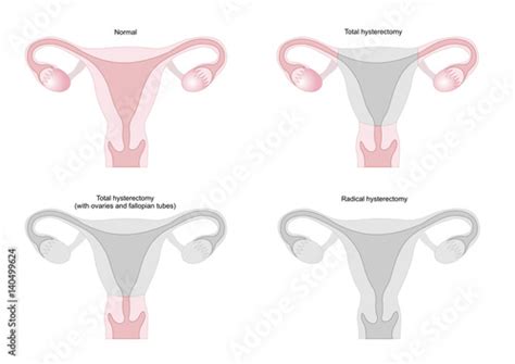 Hysterectomy Surgical Removal Of The Uterus And In Some Cases Of