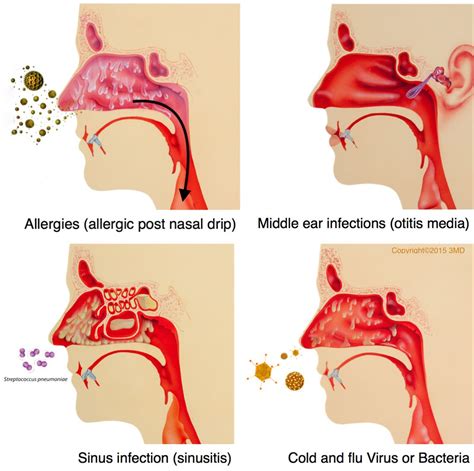 how to cure a post nasal drip sore throat mishkanet