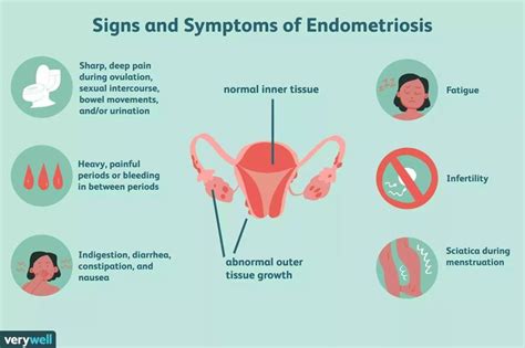 Symptoms Of Endometriosis Women Fitness Magazine Endometriosis