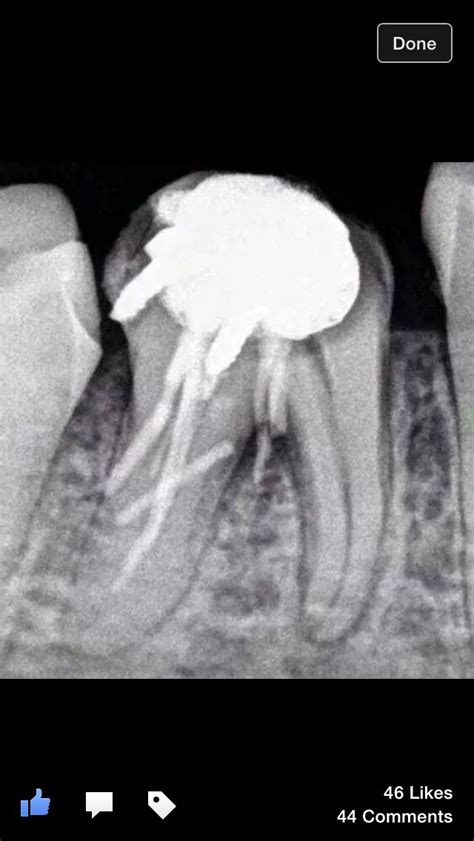 Can You Figure Out What Is Wrong With This Rootcanal Work Life