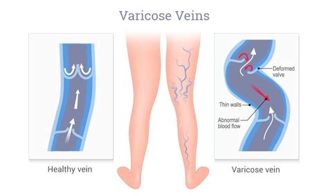 Leg Swelling And Leg Pain In Relation To Varicose Veins Dr